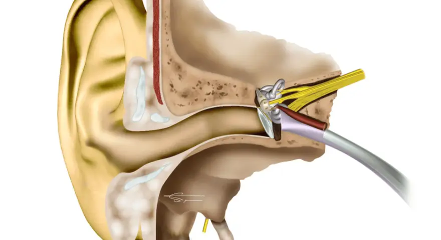 Coupe anatomique de l'oreille montrant les structures internes, y compris le tympan et les osselets, qui peuvent être affectés par une distorsion sonore oreille.