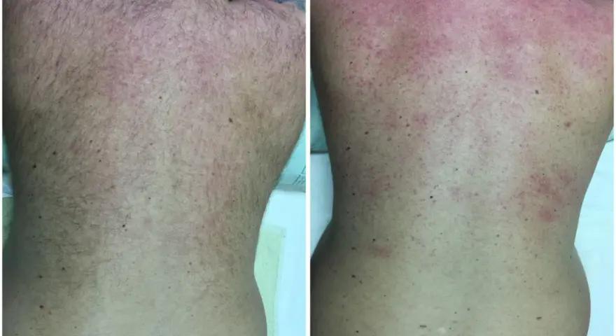 Comparación de la espalda antes y después de un intento de como depilarse la espalda uno mismo. La imagen de la derecha muestra irritación y enrojecimiento.