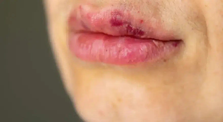 Usta z zaczerwienieniem i siniakami, możliwe kwas hialuronowy efekty uboczne po zabiegu.