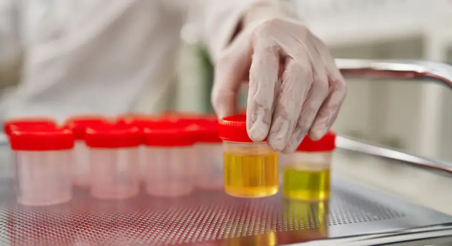Ręka w rękawiczce laboratoryjnej wybiera pojemnik z żółtym płynem. W tle widać rząd podobnych pojemników. Badanie może wykazać ketony w moczu, a odwodnienie.