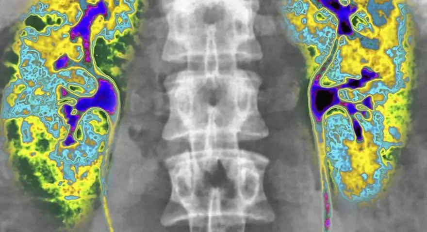 Kolorowa scyntygrafia kości pokazuje kręgosłup i obszary o zwiększonej aktywności metabolicznej, sugerujące potencjalne problemy.