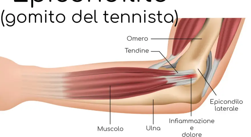Illustrazione anatomica del gomito del tennista, evidenziando infiammazione e dolore all'epicondilo laterale.