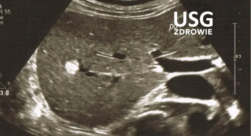 Obraz USG jamy brzusznej z widocznym jasnym ogniskiem. Czy usg jamy brzusznej wykryje raka? To badanie pomaga ocenić narządy wewnętrzne.