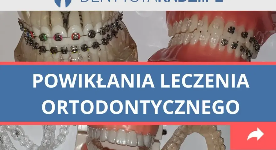 Ból zębów po aparacie? 7 szybkich ulg i co robić dalej