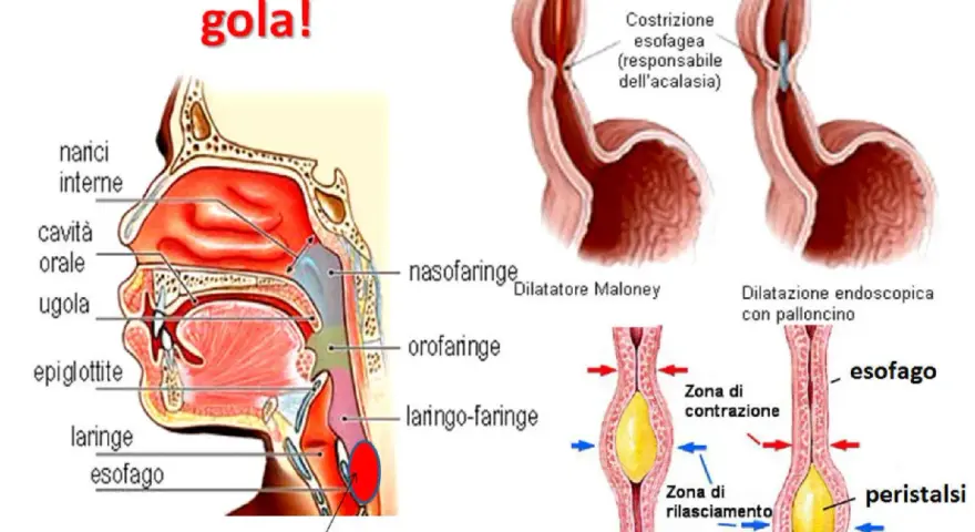 Illustrazione anatomica della gola e dell'esofago, che mostra come un bolo possa causare la sensazione di sentire qualcosa in gola.