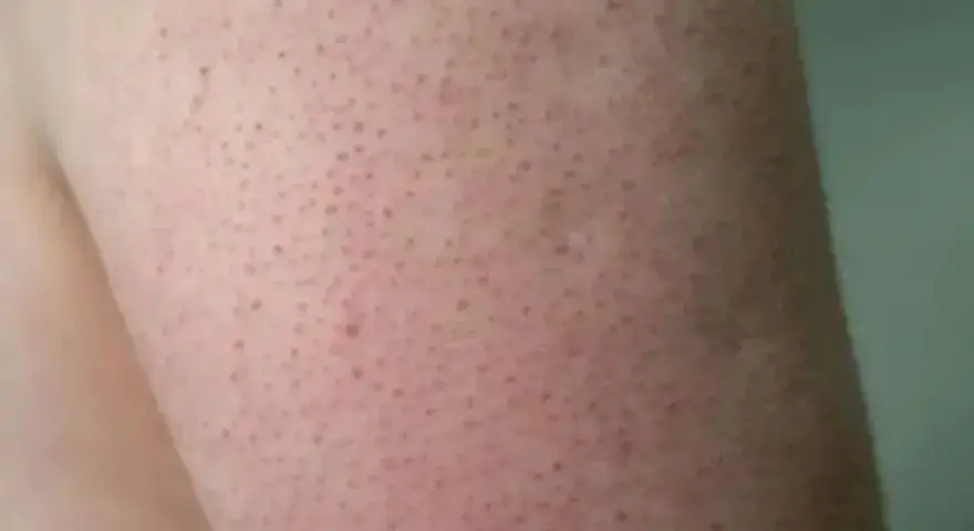 Piel de fresa con pequeños puntos oscuros, como si fueran semillas, en un brazo.
