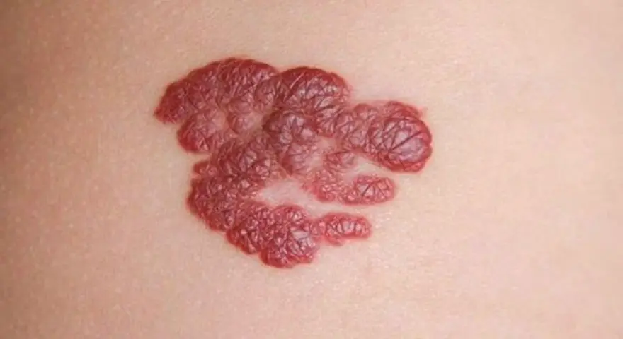 Ein roter, unregelmäßiger Hautfleck, der als mögliches Hautkrebs-Symptom betrachtet werden könnte.