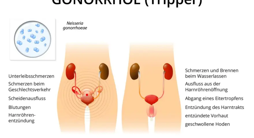 Darstellung von Gonorrhoe (Tripper) bei Frauen und Männern mit Symptomen wie Unterleibsschmerzen, Ausfluss und Entzündungen.