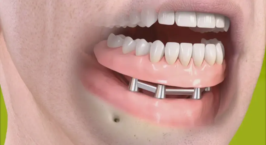 Implant zębowy: Bez bólu i strachu? Poznaj 5 etapów zabiegu