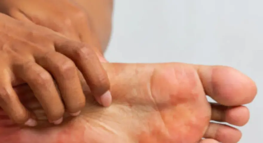 Una persona se rasca el pie, mostrando enrojecimiento e irritación. ¿Cómo saber si tengo hongos en los pies?