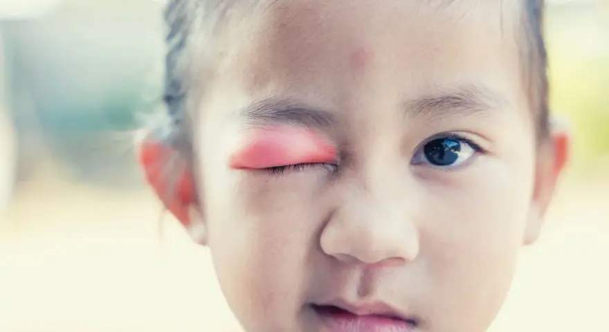 Bambina con occhio gonfio e arrossato, possibile segno di infezione o allergia. Le cause degli occhi gonfi nei bambini sono varie.