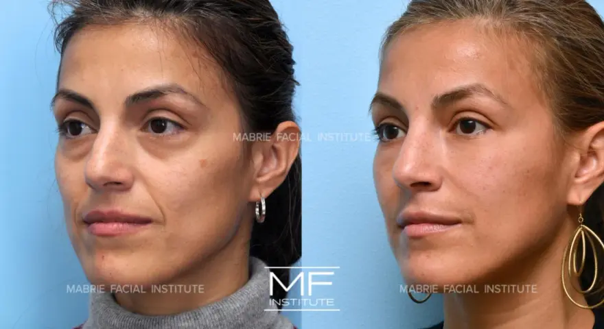 Before and after images show a woman's face, highlighting the reduction of nasolabial folds after a facial massage.