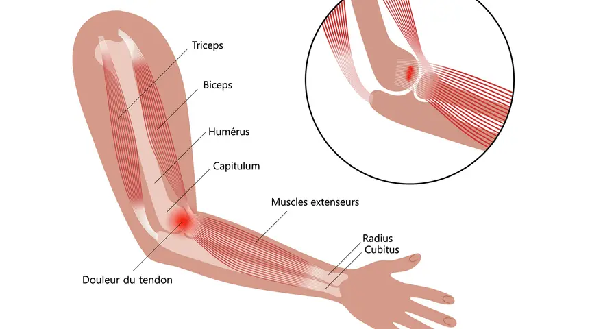 Illustration anatomique montrant une tendinite à l'intérieur du coude, avec douleur au tendon des muscles extenseurs.