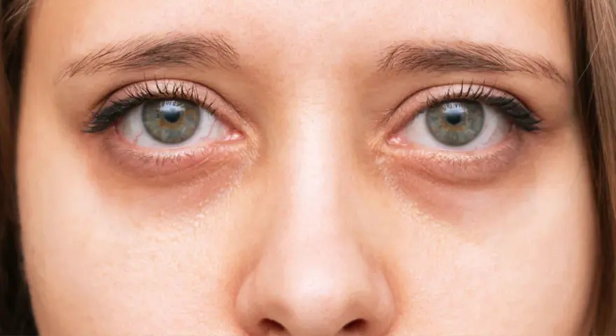 Primer plano de unos ojos con ojeras marcadas. Consejos para como quitar ojeras y lucir una mirada más descansada.