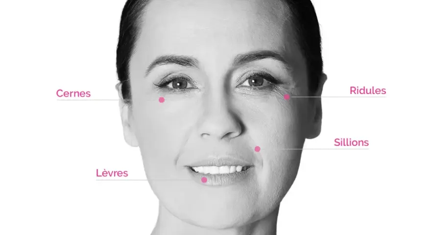 Visage marqué par des rides et cernes. Des points indiquent les zones d'application pour un avis sur l'acide hyaluronique.