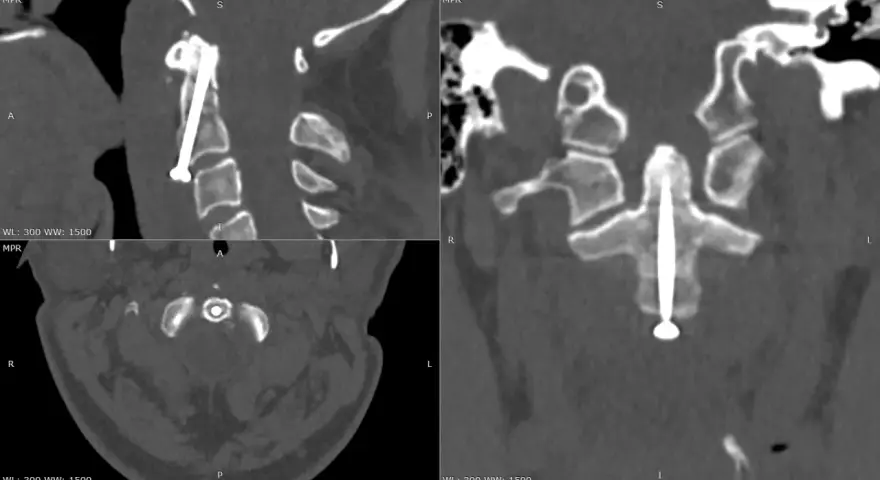 Widok CT kręgosłupa szyjnego po operacji. Widoczny implant stabilizujący, śruba przechodzi przez ząb obrotnika.