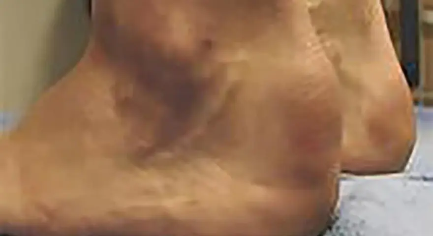 Gros plan sur un talon, suggérant une tendinite du tendon d'Achille. La peau semble légèrement rougie par endroits.