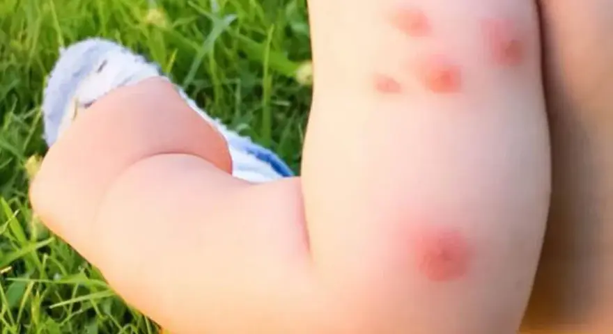 Bebé con varias picaduras de mosquito rojas e inflamadas en su brazo, jugando en el césped.