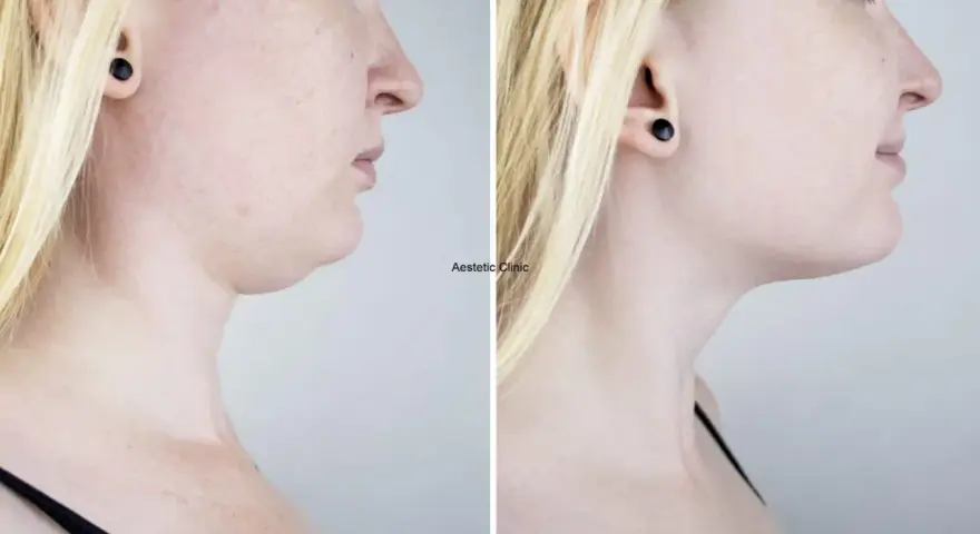 Przed i po zabiegu: widoczna redukcja podwójnego podbródka dzięki lipolizie. Efekty lipolizy podbródka są spektakularne.