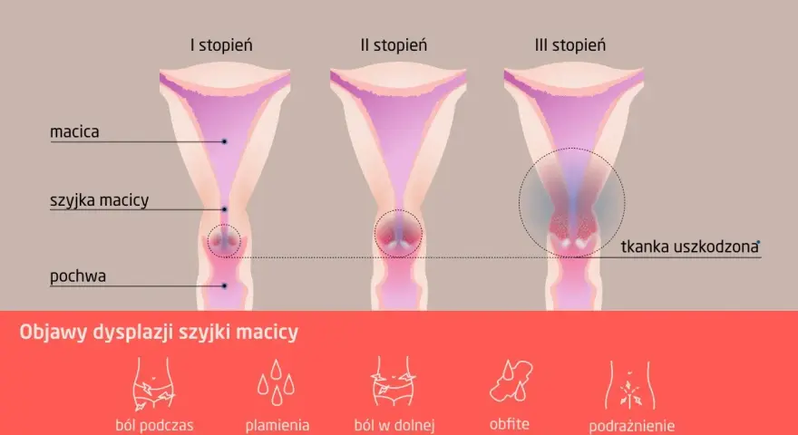 Ilustracja przedstawia trzy stadia dysplazji szyjki macicy: I, II i III stopień, z zaznaczonymi objawami.