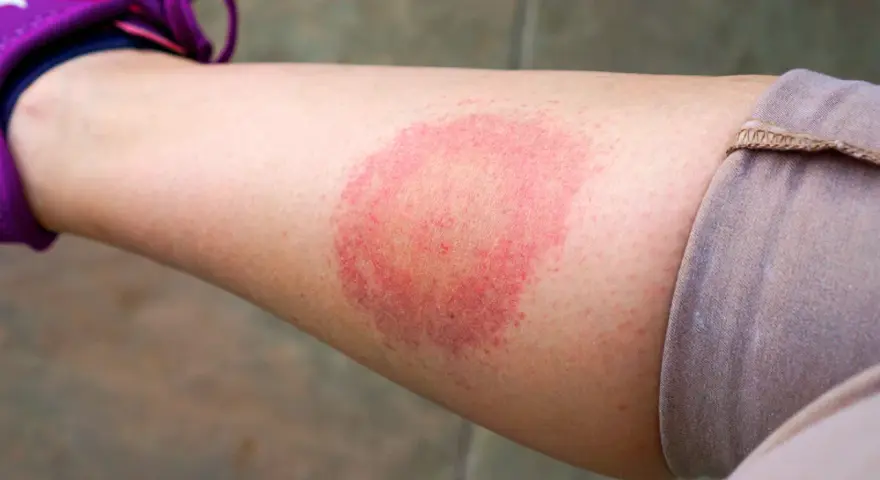 Borrelien Symptome beim Menschen: Warnzeichen, die Sie nicht ignorieren sollten