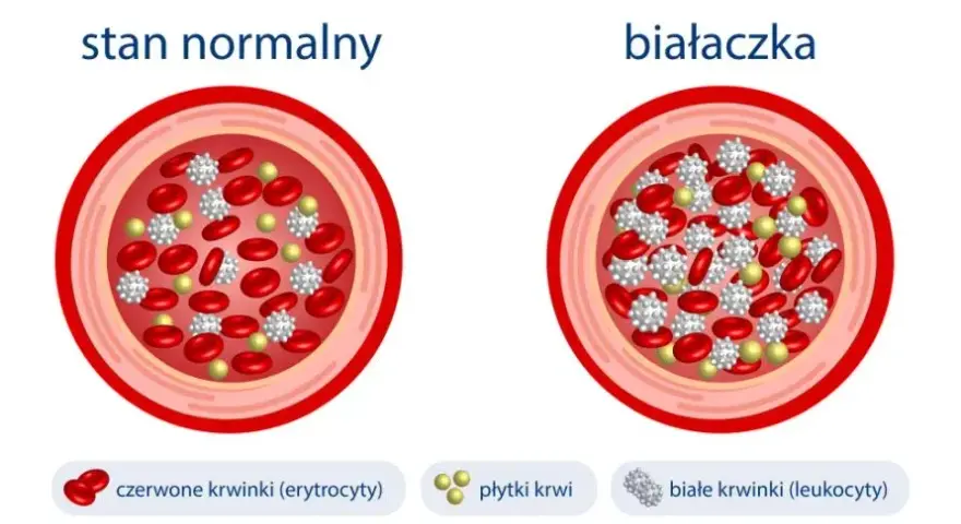 Objawy białaczki u niemowlaka - jak je rozpoznać i kiedy działać