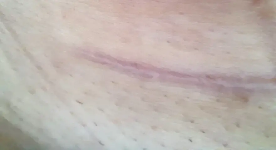 Widoczna blizna na szyi po operacji, lekko różowa, z drobnymi włoskami na skórze.