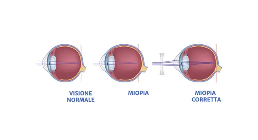 Diagrammi oculari mostrano visione normale, miopia e miopia corretta. I sintomi della miopia degenerativa sono visibili nel secondo occhio.