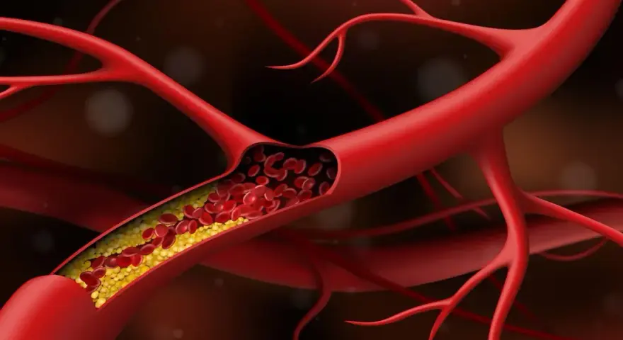 Przekrój naczynia krwionośnego z żółtymi złogami cholesterolu, które powodują, że naczynia krwionośne obkurczają się, utrudniając przepływ krwi.