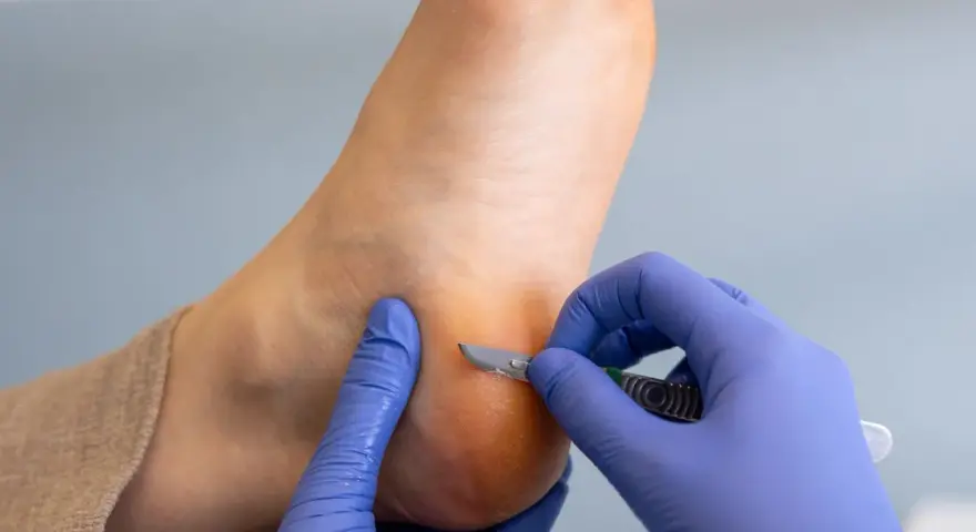 Un podologue enlève délicatement une croute sur le talon d'un pied avec un scalpel.