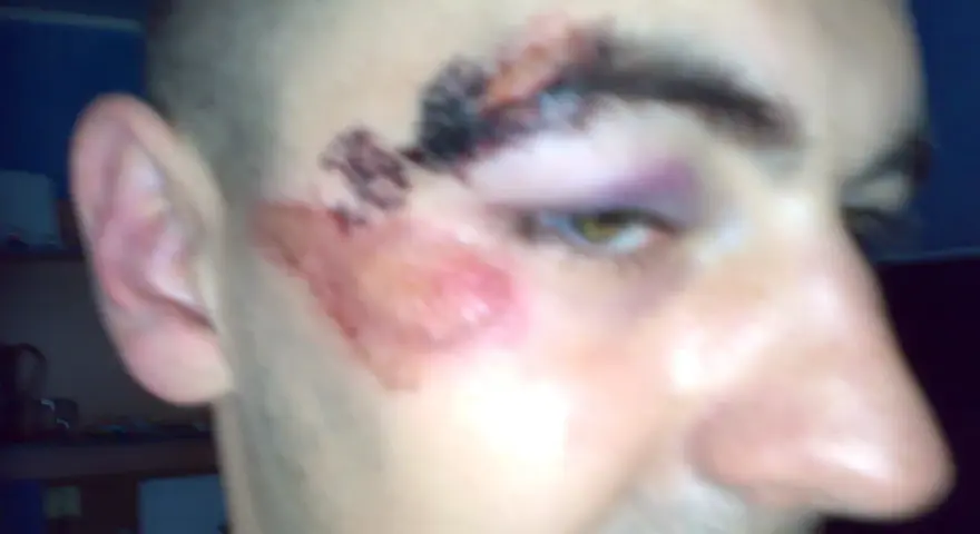 Rozcięty łuk brwiowy z siniakiem i otarciem na policzku.