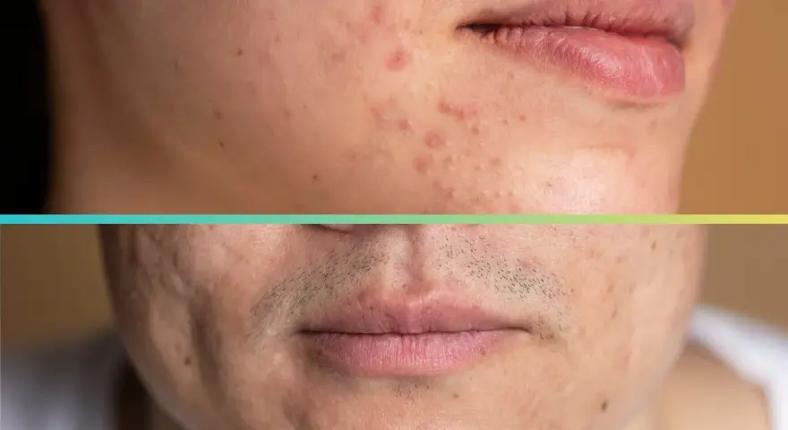 Primo piano di un volto con macchie da acne, prima e dopo il trattamento dermatologico.