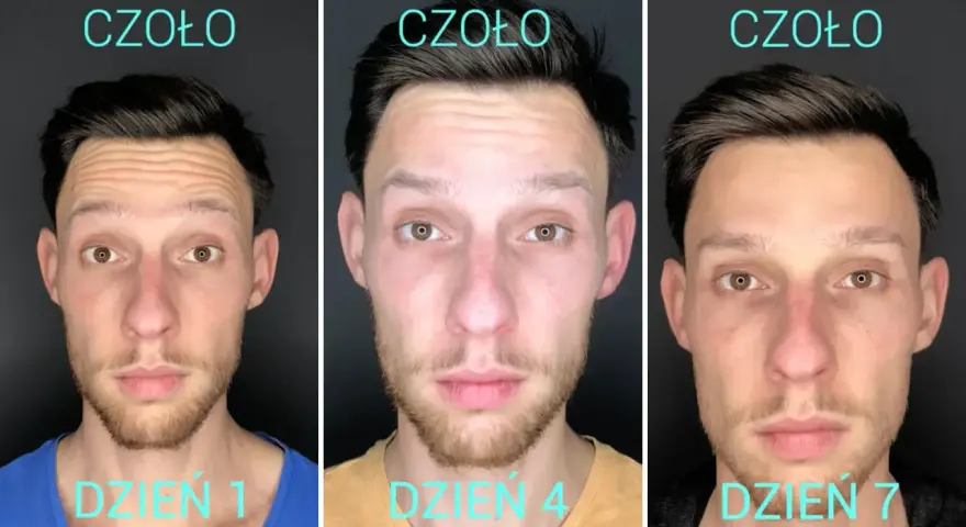 Ewolucja czoła: dzień 1, 4 i 7. Widoczne wygładzenie zmarszczek po zabiegu, kiedy mezoterapia po botoksie przynosi efekty.