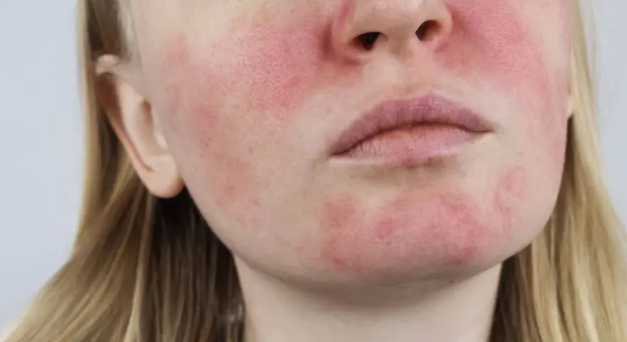 Nahaufnahme eines Gesichts mit Rötungen und sichtbaren Poren, die auf Rosacea und fettige Haut hindeuten.