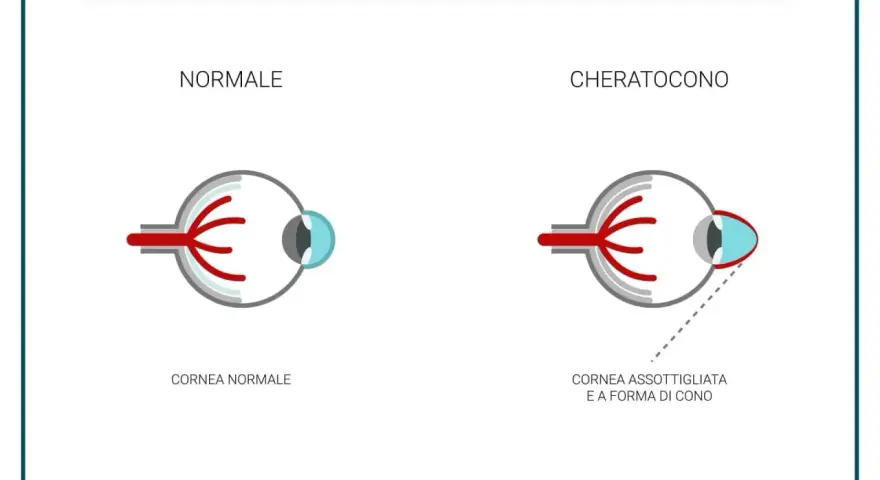 Confronto tra occhio normale e occhio con cheratocono, evidenziando la cornea assottigliata e a forma di cono, uno dei principali cheratocono sintomi.