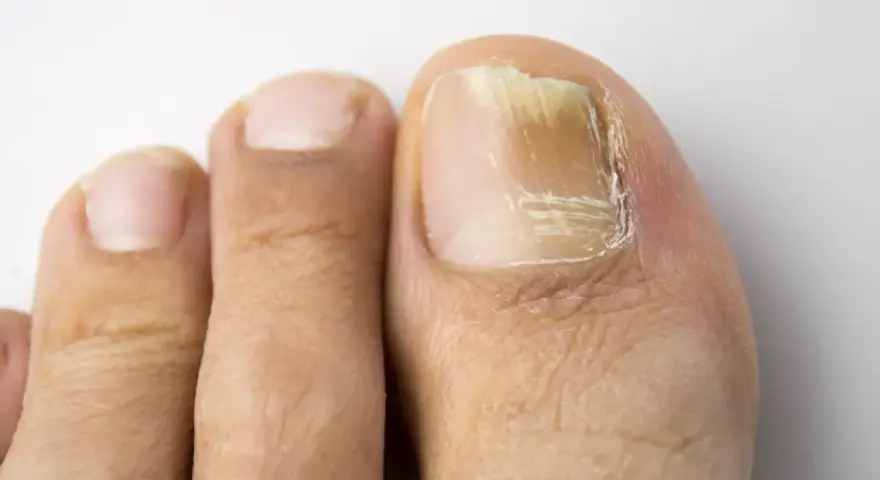 Gros plan sur un ongle de pied atteint de mycose, jauni et épaissi. Une solution naturelle à base d'huile essentielle pourrait aider.