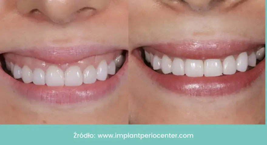 Uśmiech przed i po: zredukowany gummy smile, odsłonięte piękne, białe zęby.