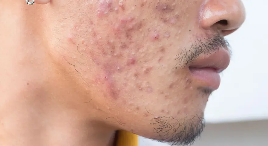 Primer plano de un rostro con acné severo, mostrando granos de pus grandes y enrojecimiento.