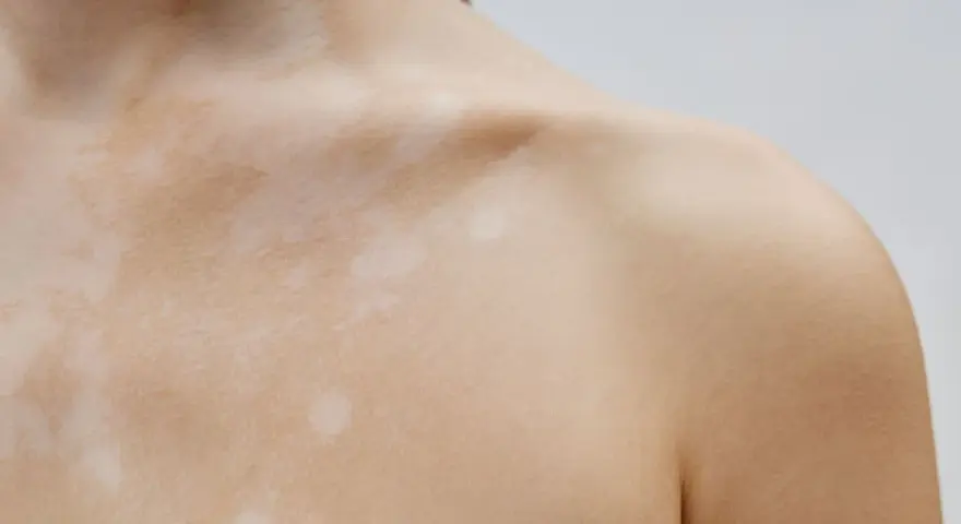 Piel con manchas claras, como si fueran **hongos en la espalda**, cubriendo el cuello y hombro.