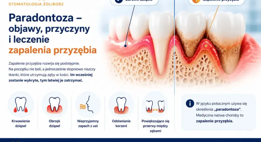 Zapalenie przyzębia: objawy to krwawienie, obrzęk dziąseł, nieprzyjemny zapach, odsłonięte korzenie i przerwy między zębami. Wczesne wykrycie kluczowe.