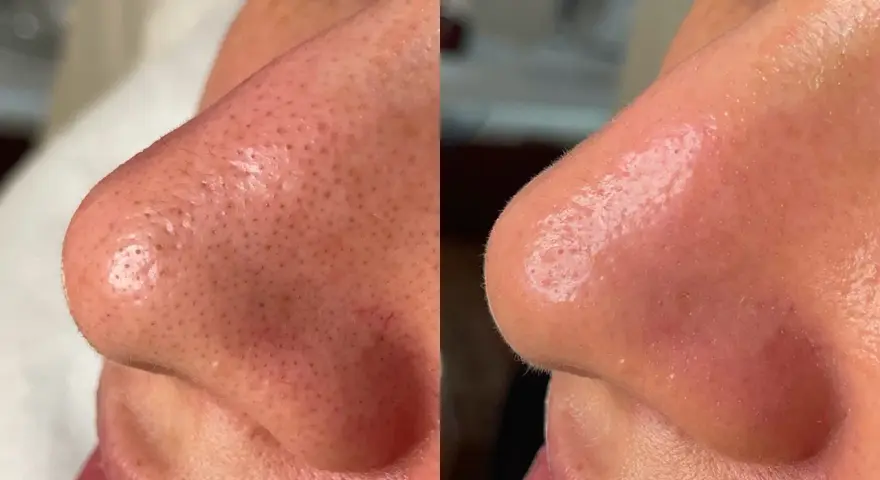 Before and after a hydro infusion facial, showing a nose with visible pores and blackheads transformed into smoother, clearer skin.