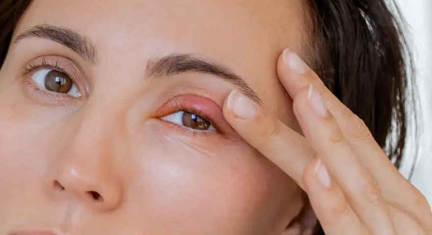 Un orgelet sur la paupière, peut-être causé par la fatigue, rend le regard moins vif.