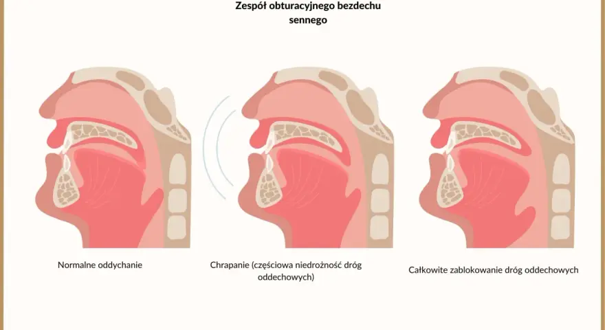 Ilustracja pokazuje przekrój dróg oddechowych: normalne oddychanie, chrapanie (częściowa niedrożność) i całkowite zablokowanie, które może powodować brak oddechu w nocy nerwica.