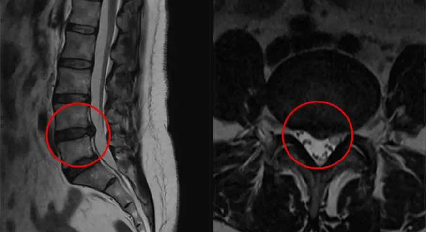 MRI kręgosłupa lędźwiowego z zaznaczoną przepukliną. Czy przepuklina kręgosłupa jest groźna? Obraz pokazuje, że tak, może uciskać nerwy.