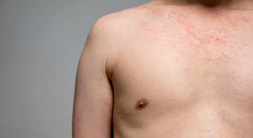 Eruzione cutanea rossa sul petto e sulla spalla, forse causata da un tessuto sintetico. L'elastan fa male alla pelle sensibile.