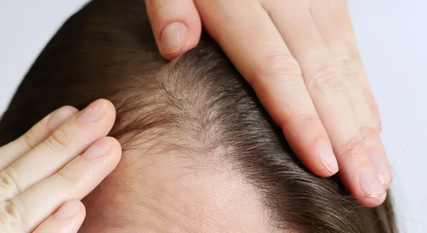 Manos tocando el cuero cabelludo, mostrando finos cabellos y piel. Podría indicar dolor cuero cabelludo o preocupación por la pérdida de cabello.