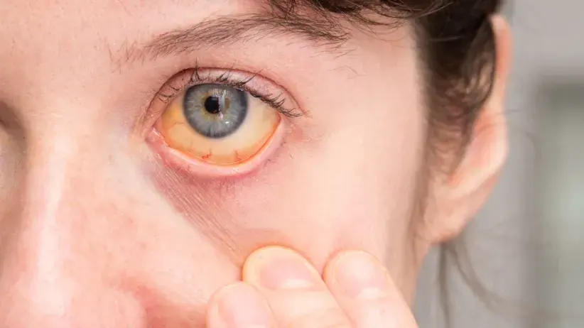 Jadłowstręt psychiczny objawy: jak rozpoznać niebezpieczne symptomy