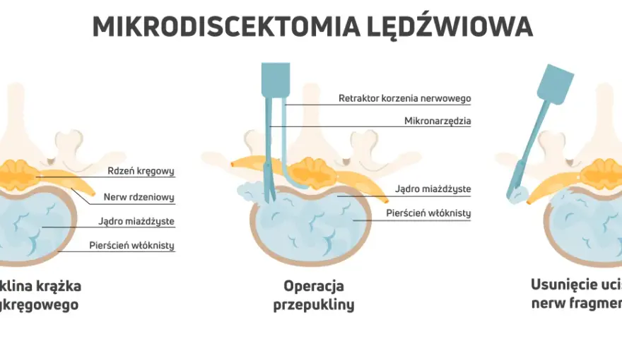 Ilustracja pokazuje mikrodiscektomię lędźwiową: przepuklinę, operację i usunięcie fragmentu krążka. Pamiętaj, czego nie wolno robić po operacji kręgosłupa lędźwiowego.