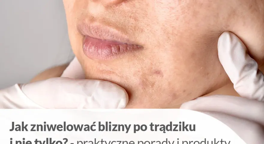 Jak pozbyć się blizn po pryszczach? Skuteczne metody i porady eksperta