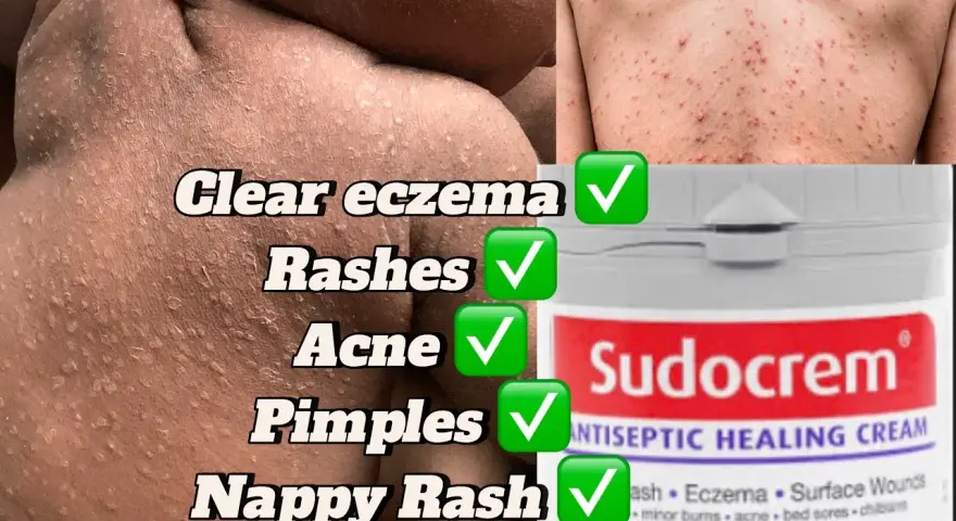 Sudocrem na pryszcze: Czy działa? Jak stosować bezpiecznie?